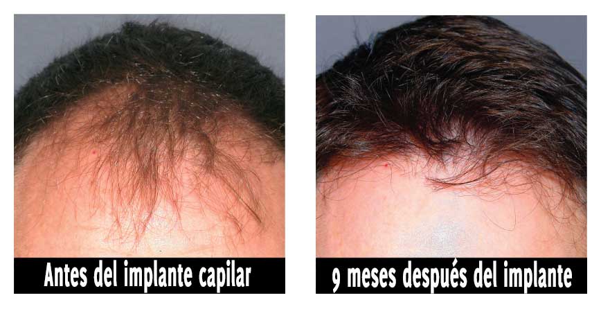 Tratamientos Para Después De Un Trasplante Capilar - Instituto Del Pelo