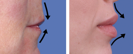 Izquierda: efectos del envejecimiento .Derecha: volúmenes y posición característica del labio juvenil.