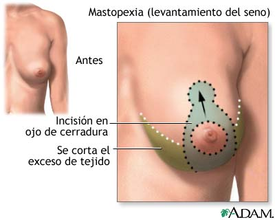 mastopexia